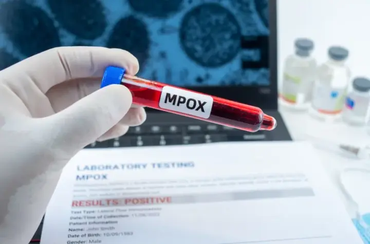 doenca mpox casos — BR news