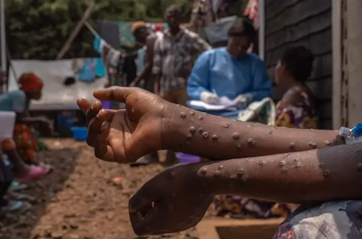 mpox casos — BR news